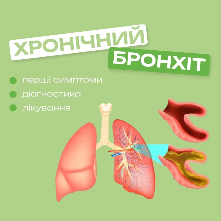 Чим лікувати бронхіт: доказовий підхід до відновлення дихання
