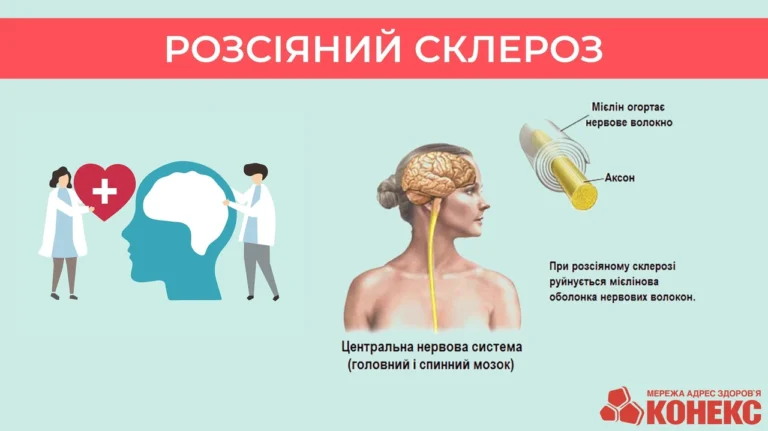 Сколько живут с рассеянным склерозом: реальные цифры и ключевые факторы 2026